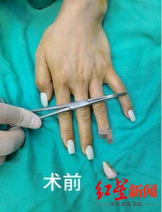 因美甲过厚导致感知失灵，女子不幸手指被夹断